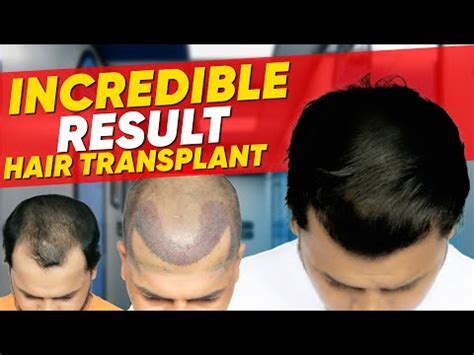 Haartransplantatie DHI: Alles Wat Je Moet Weten