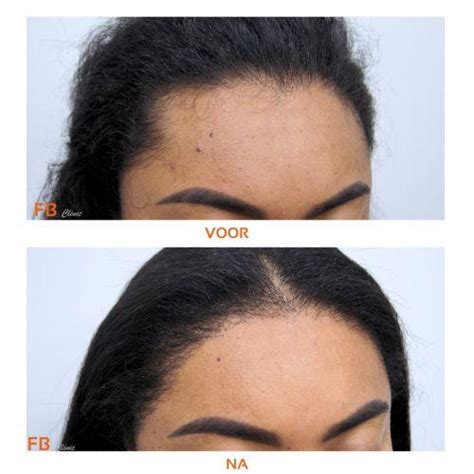 Haartransplantatie Voor Vrouwen: Feiten En Mythes